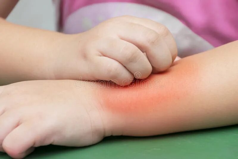 Расчесанные укусы фото Children Mosquito Bites on the Legs Stock Image - Image of bite, infant: 4897614