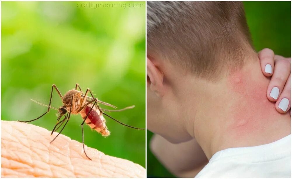 Расчесанный укус комара фото Why Do my Mosquito Bites Sting and Swell?