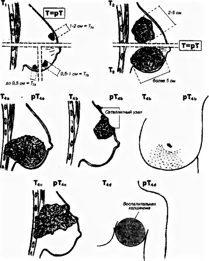 Распад опухоли молочной железы 4 стадия фото Распад Опухоли Молочной Железы Фото - 34580011.ru