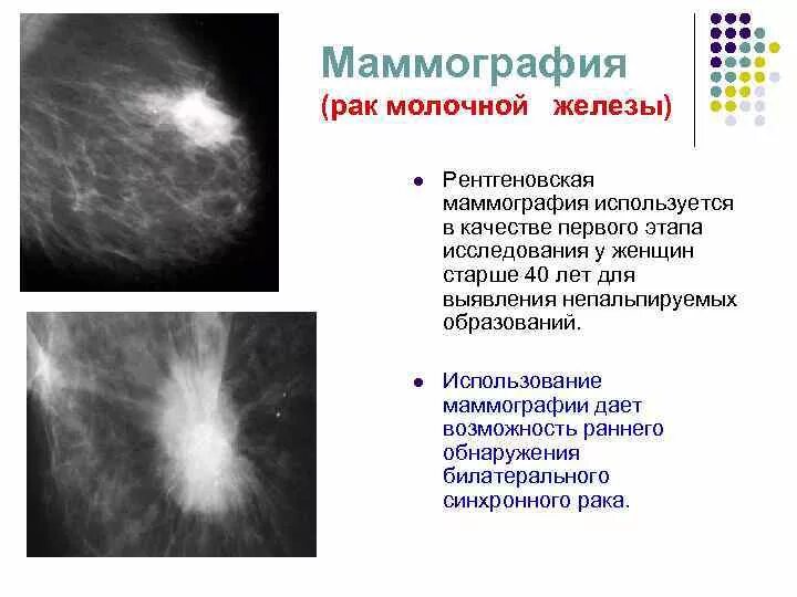 Распад опухоли молочной железы 4 стадия фото Рмж 1 стадия гормонозависимый