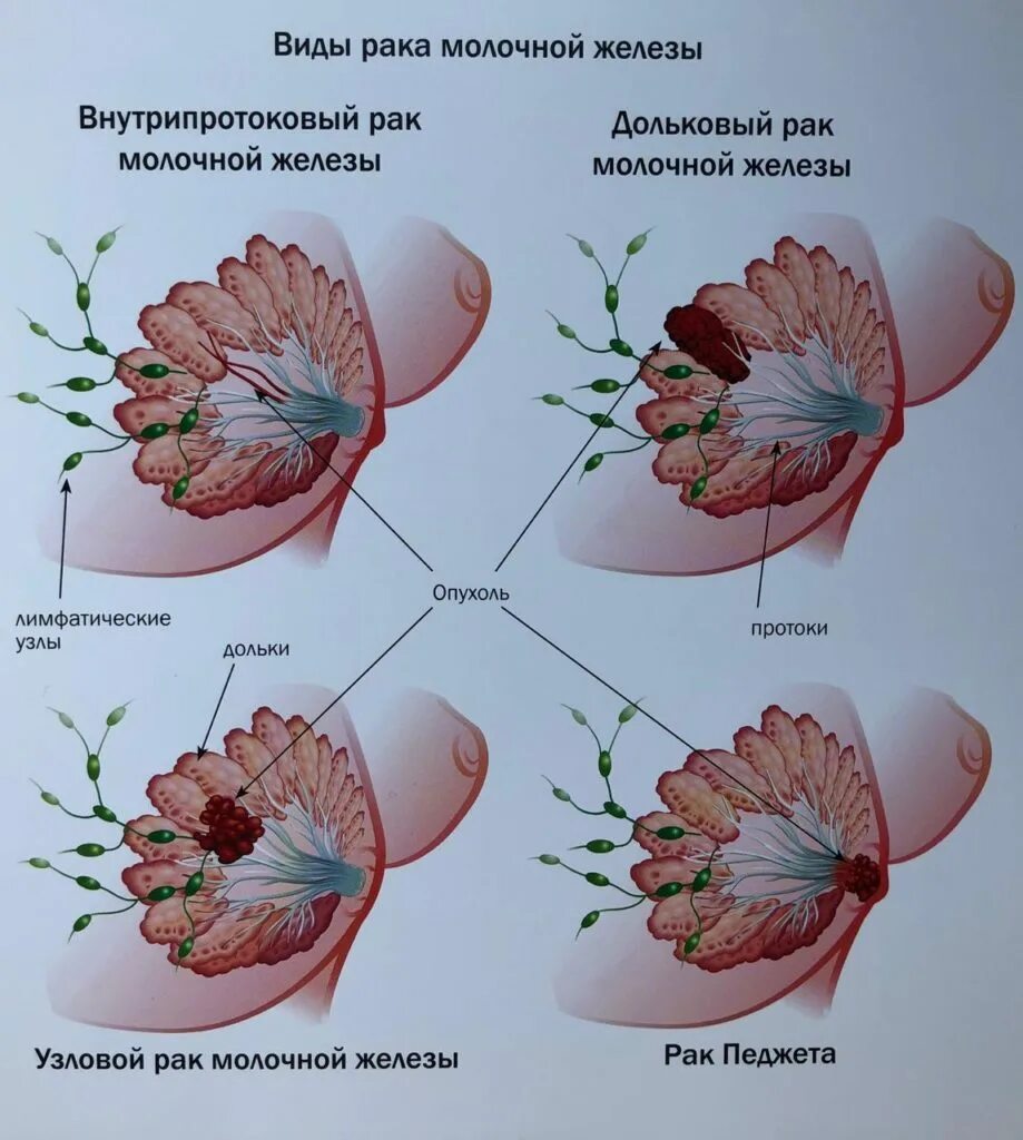 Распад опухоли молочной железы 4 стадия фото Злокачественные образования молочной железы - Ежиков Александр Леонидович