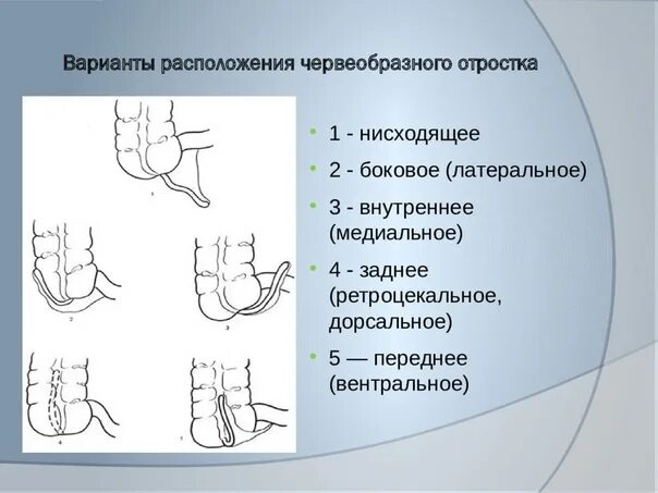 Расположение аппендицита у человека схема #госпитальная_хирургия_1_тема@otv6k Особенности клинической картины при атипично