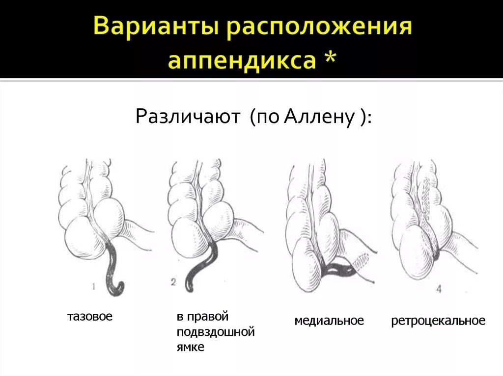 Расположение аппендицита у человека схема Классификация аппендицита - найдено 85 картинок