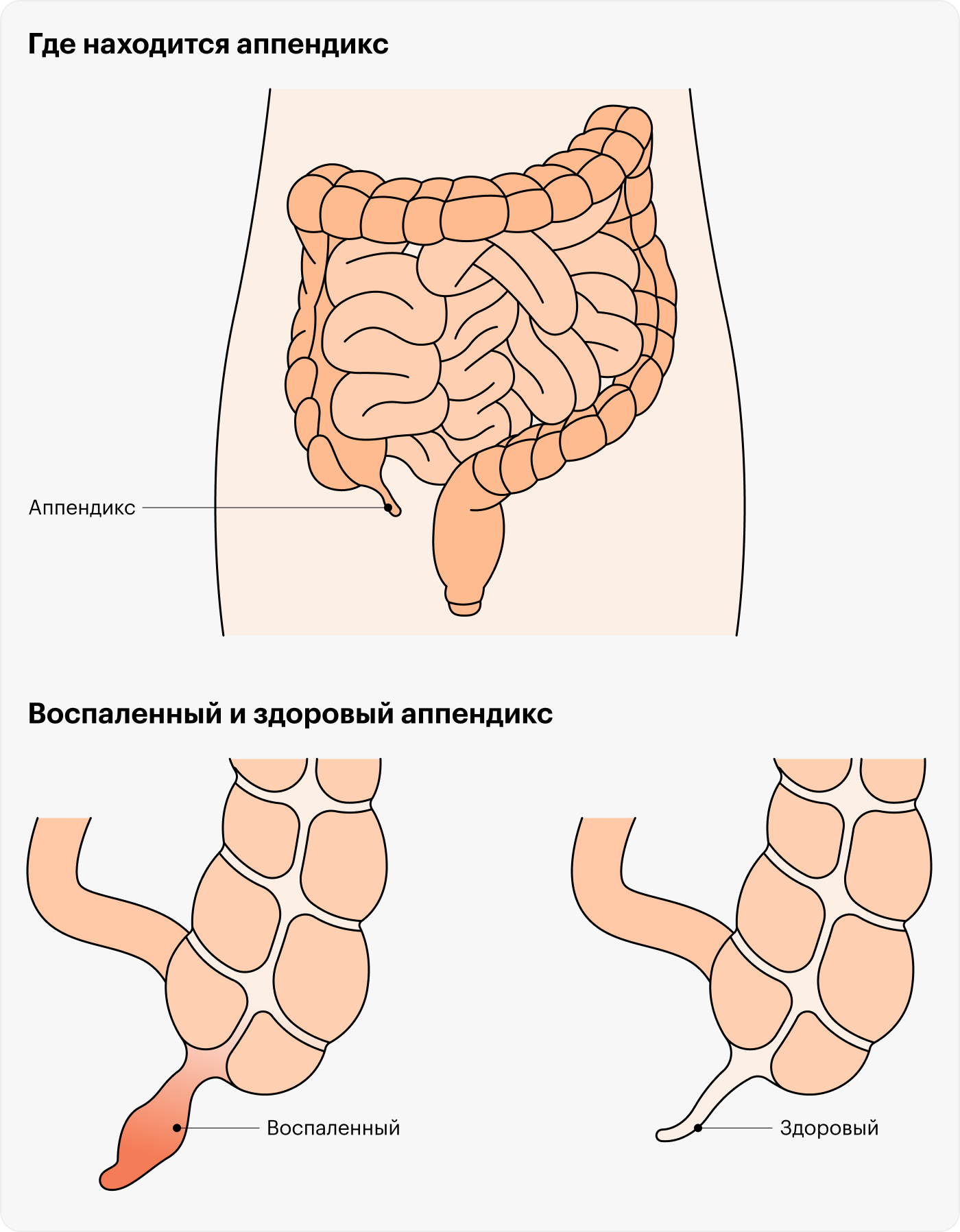 Расположение аппендицита у человека схема Аппендицит: симптомы, признаки, с какой стороны болит, операция по удалению, как