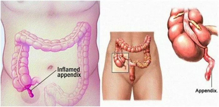 Расположение аппендицита у человека схема С какой стороны аппендицит? Как определить аппендицит у взрослых, подростков, де