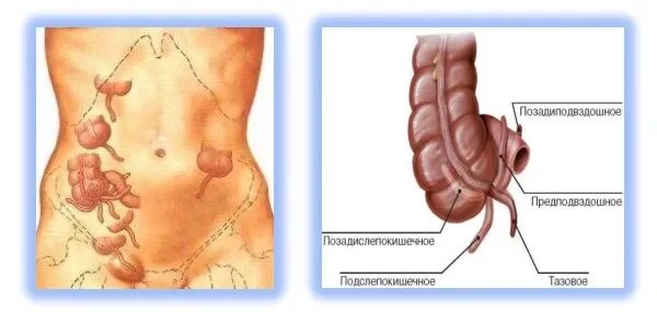 Расположение аппендицита у человека схема Дифференциальная диагностика острого аппендицита