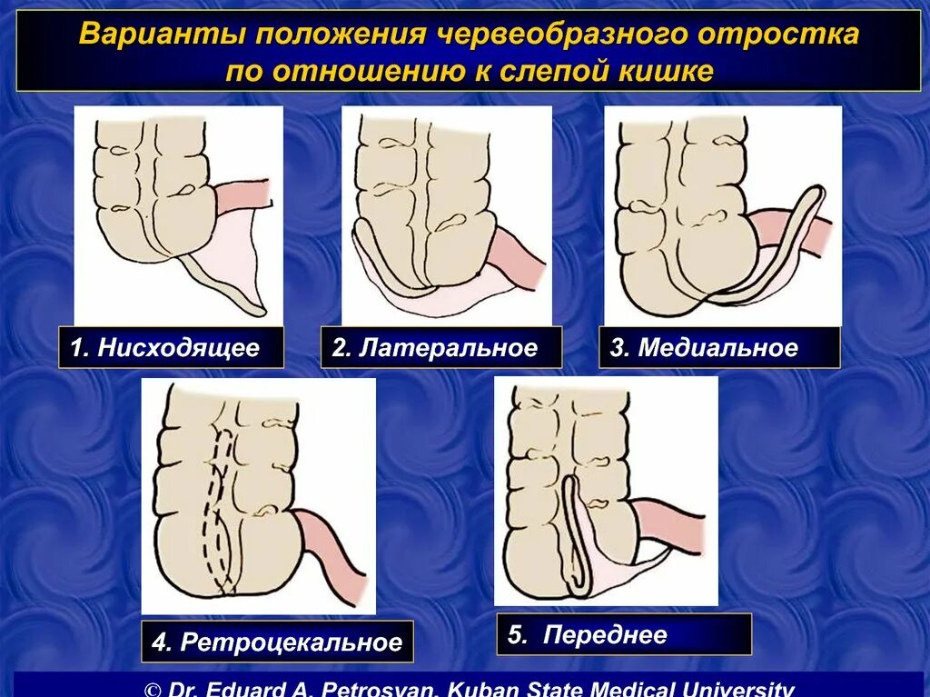 Расположение аппендицита у человека схема 102. Операции на поджелудочной железе. Топографо-анатомическое обоснование, опер