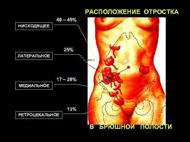 Расположение аппендицита у человека схема О С Т Р Ы Й АППЕНДИЦИТ ЛЕКЦИЯ