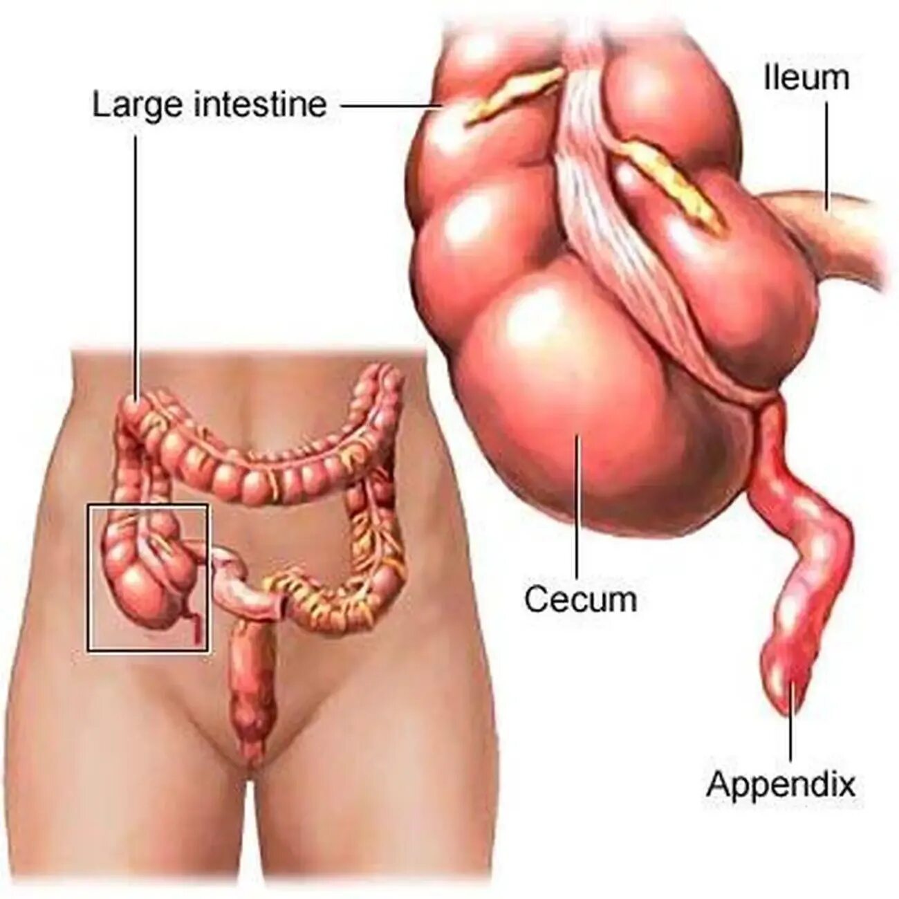 Расположение аппендицита у человека схема Pictures Of Cecum Healthiack