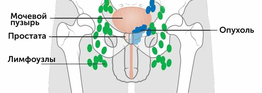 Расположение лимфоузлов в паху у мужчин схема Рак мочевого пузыря у женщин: симптомы на ранней стадии, виды онкологии и лечени