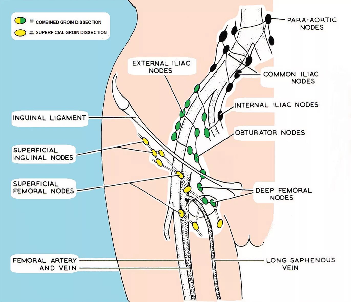 Расположение лимфоузлов в паху у женщин схема Swollen Lymph Node Bikini Line Top Sellers poligraf-ti.kz