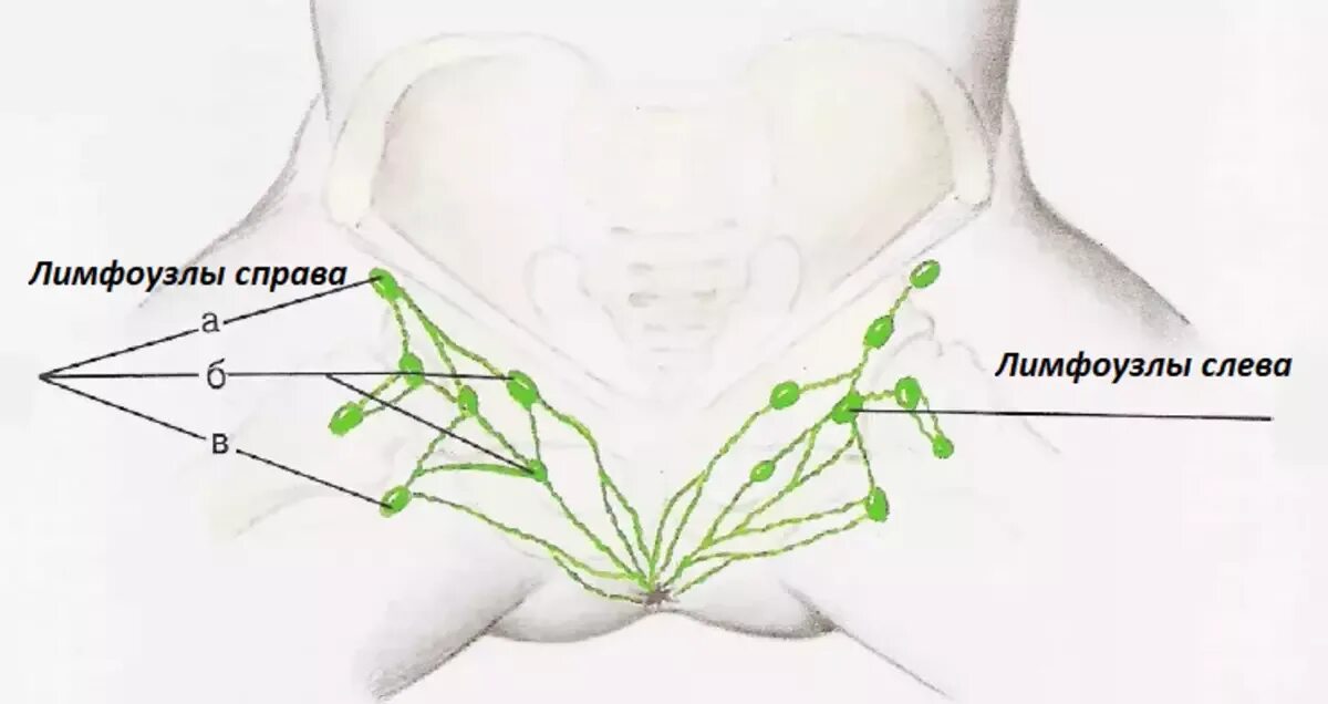 Расположение лимфоузлов в паху у женщин схема После удаления паховых лимфоузлов: найдено 25 изображений