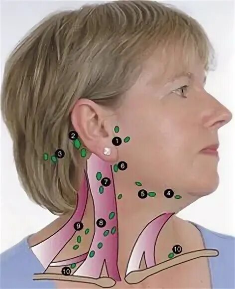 Расположение лимфоузлов возле уха фото Example of Lymph Nodes in Head and Neck Lymph massage, Head and neck cancer, Lym