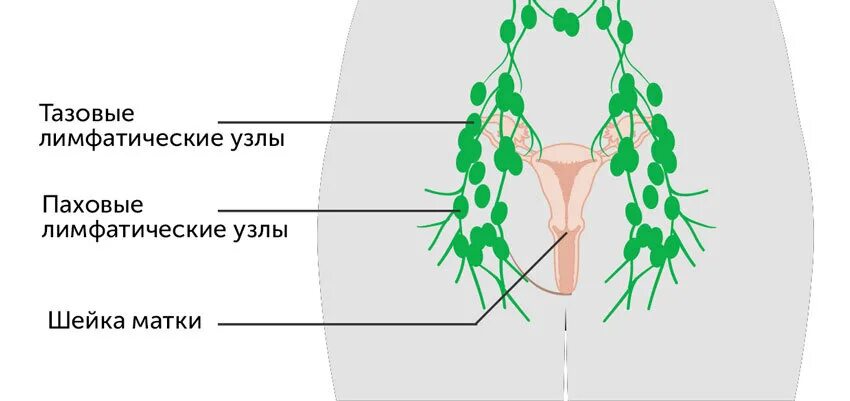 Расположение паховых лимфоузлов у женщин схема Тазовая лимфаденэктомия