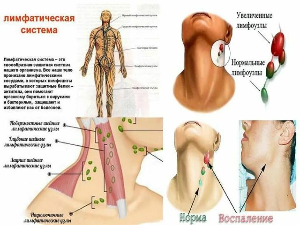 Расположение шейных лимфоузлов у человека схема Измененные лимфатические узлы