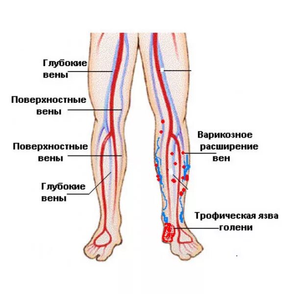 Расположение вен на ногах человека схема Трофическая язва - виды и способы лечения