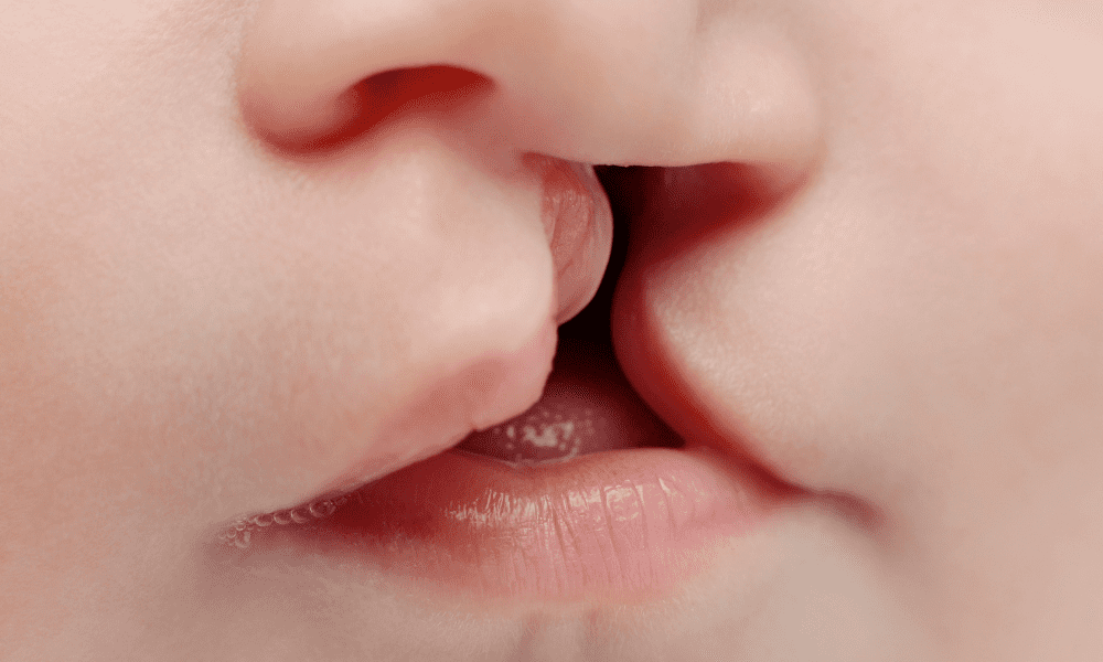 Расщелина губы и неба фото Cleft Lip and Palate - All the Things You Should Know About: Kirkland Premier De