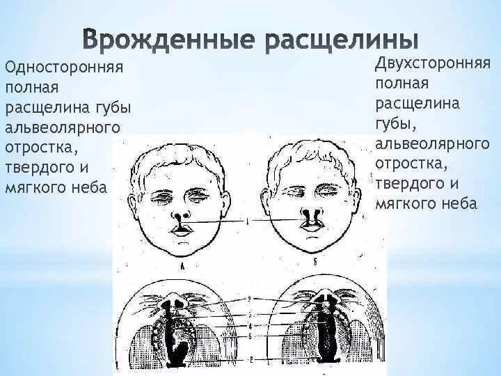 Расщелина губы и неба фото Виды расщелин губы - найдено 80 картинок