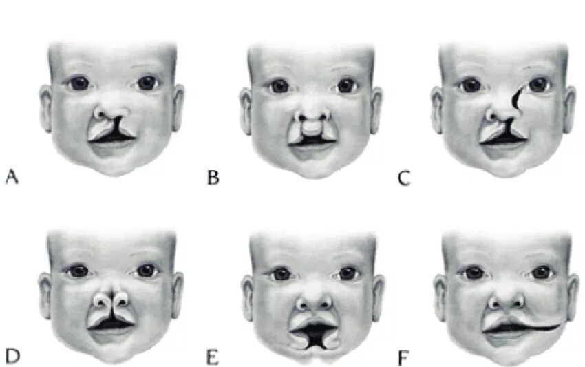 Расщелина губы и неба фото Orofacial clefts: (A) unilateral cleft lip; (B) bilateral cleft lip;... Download