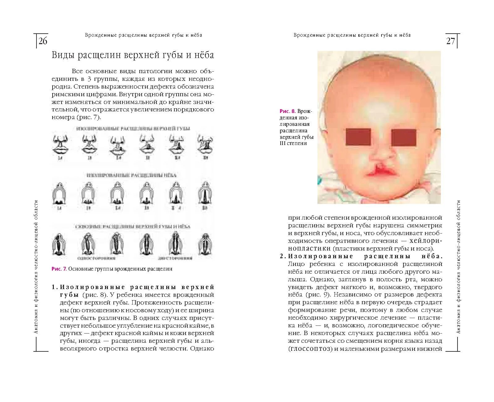 Расщелина губы и неба фото Врожденные расщелины верхней губы и нёба Дефектология Проф