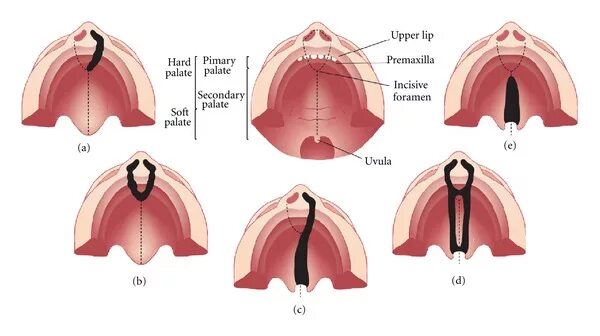 Расщелина мягкого и твердого неба фото Representation of the most common types of cleft affecting the palate.... Downlo