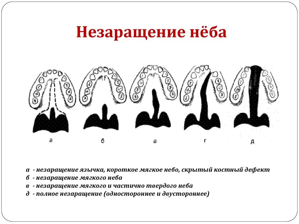 Расщелина мягкого и твердого неба фото Оперативное лечение пороков развития лица - презентация онлайн