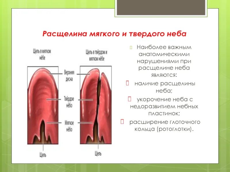 Расщелина мягкого и твердого неба фото Расщелина верхней губы и нёба презентация, доклад