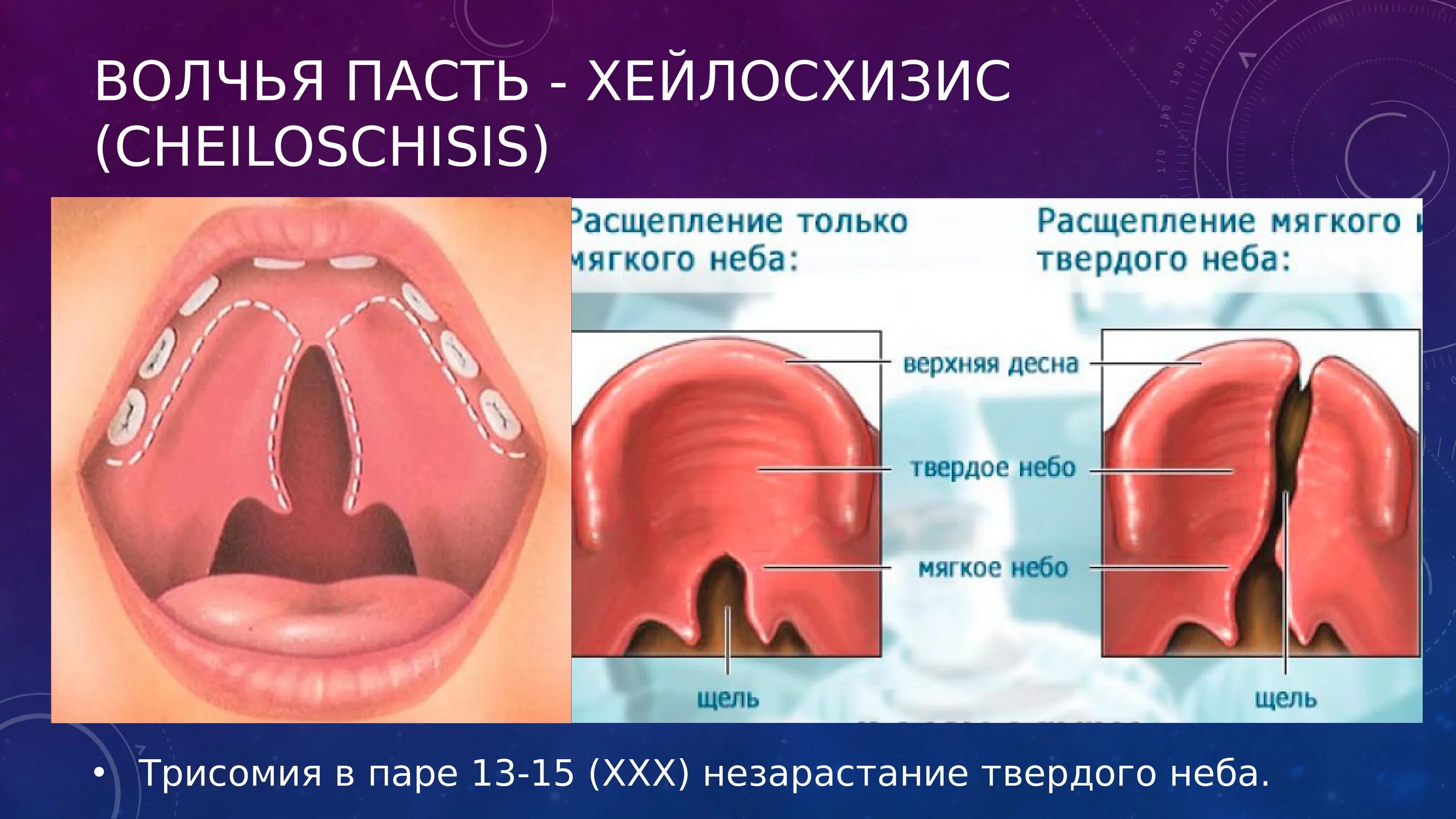 Расщелина мягкого и твердого неба фото Рисунок волчья пасть