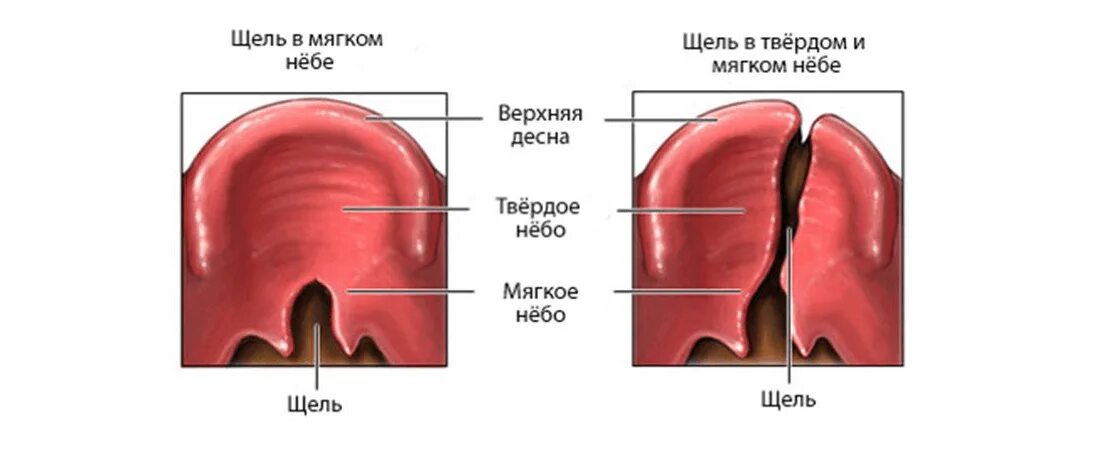 Расщелина мягкого и твердого неба фото Волчья пасть или расщелины неба Dr. Ara Hayrapetyan