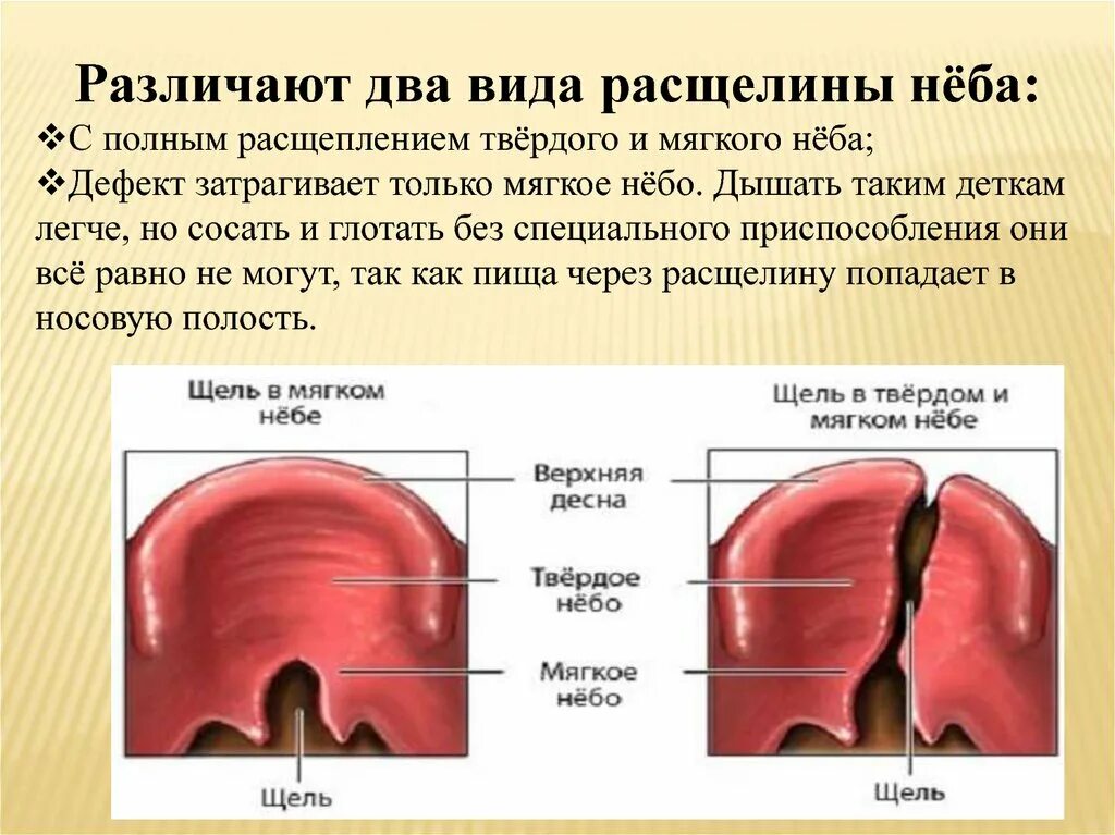 Расщелина мягкого и твердого неба фото Дефект неба: найдено 81 изображений