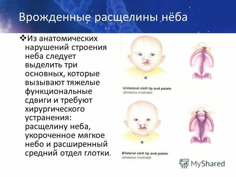 Расщелина мягкого и твердого неба фото Классификация врожденных расщелин