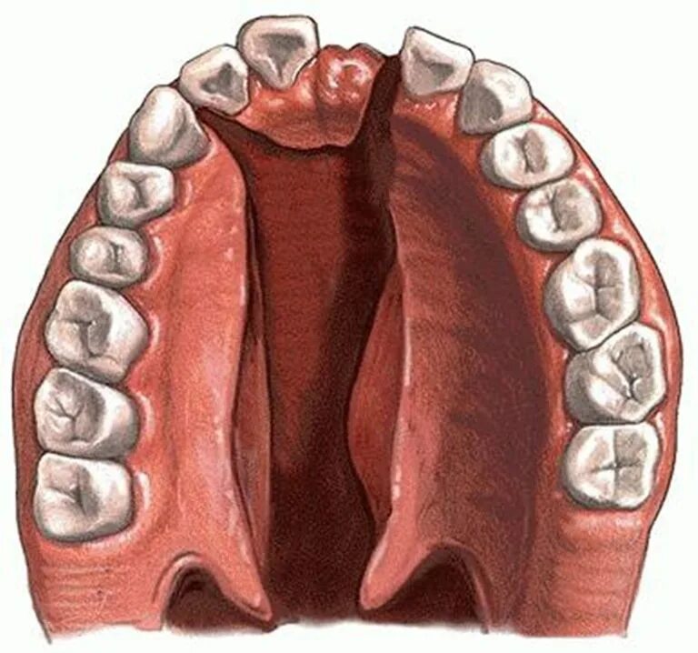 Расщелина мягкого и твердого неба фото Твёрдое нёбо и его заболевания: симптомы и лечение