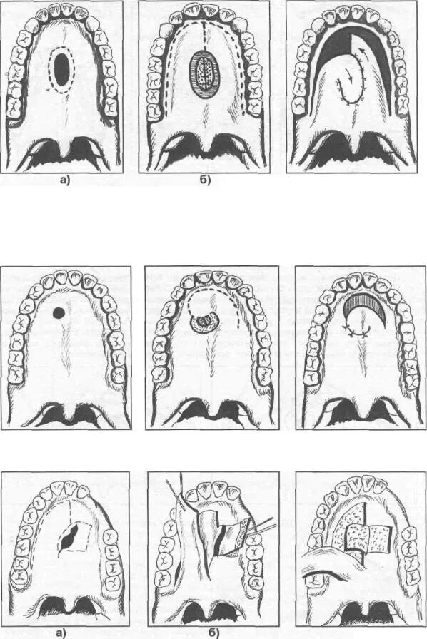 Расщелина мягкого и твердого неба фото Руководство по челюстно-лицевой хирургии и хирургической стоматологии. Тимофеева