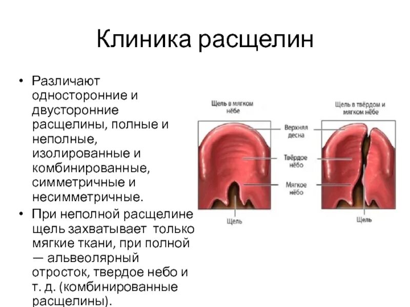 Расщелина мягкого неба фото Расщелина неба