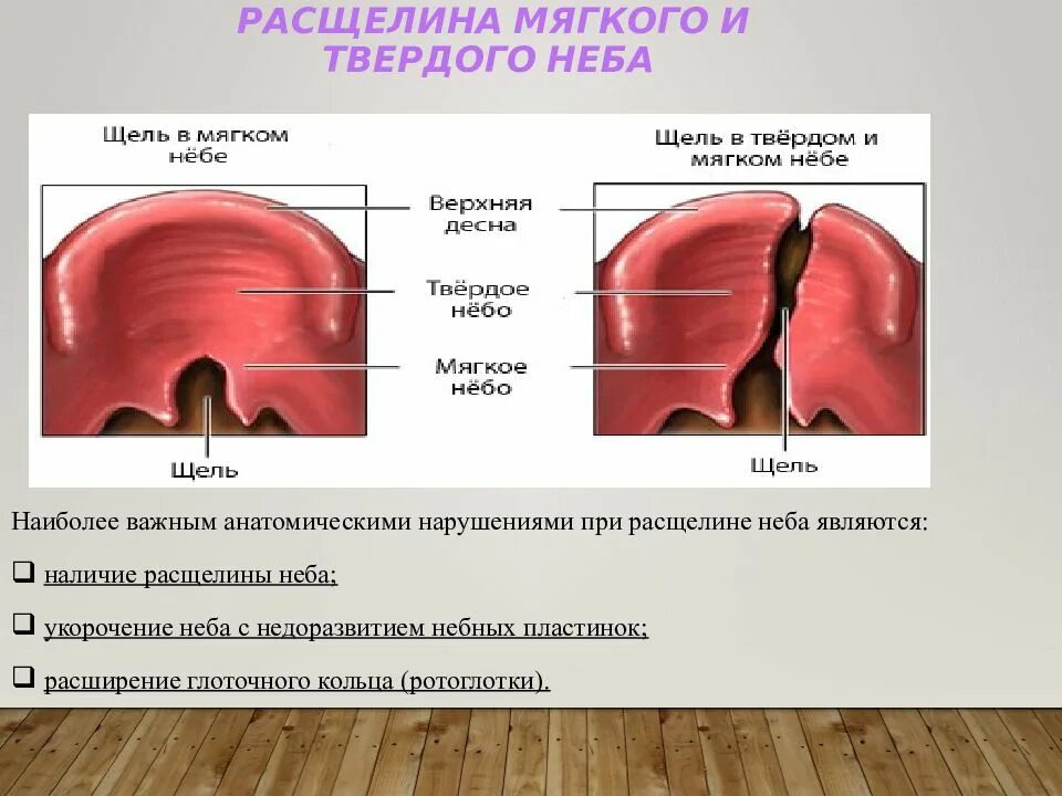 Расщелина мягкого неба фото Фото ТВЕРДОЕ НЕБО