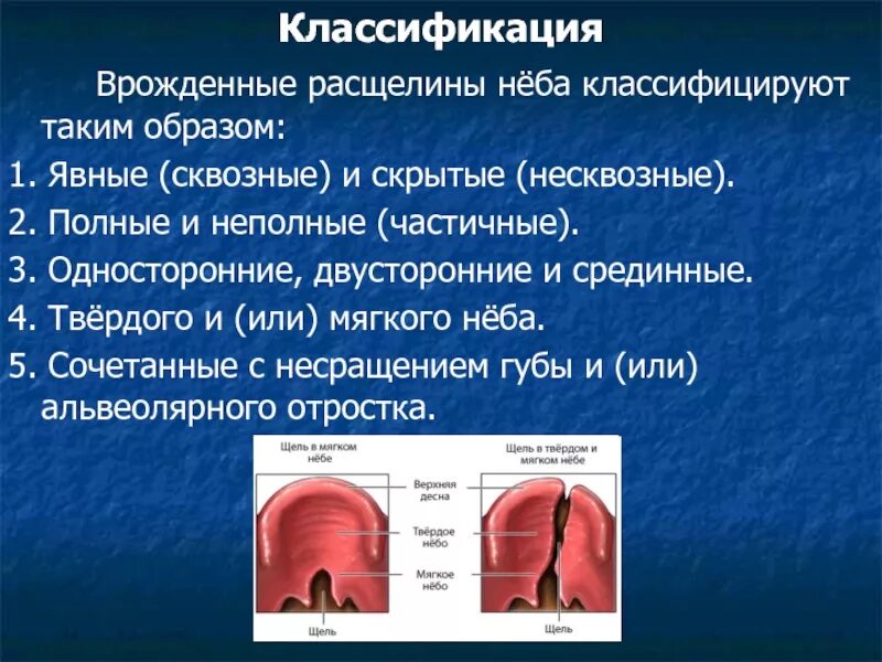 Расщелина мягкого неба фото Врожденные расщелины верхней губы и неба. Классификация, этиология, патогенез, к