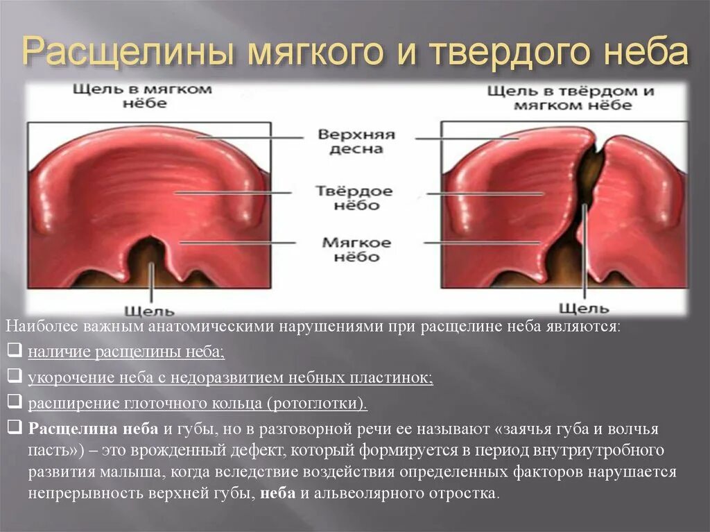 Расщелина мягкого неба фото Расщелина мягкого неба - Olphoto.ru