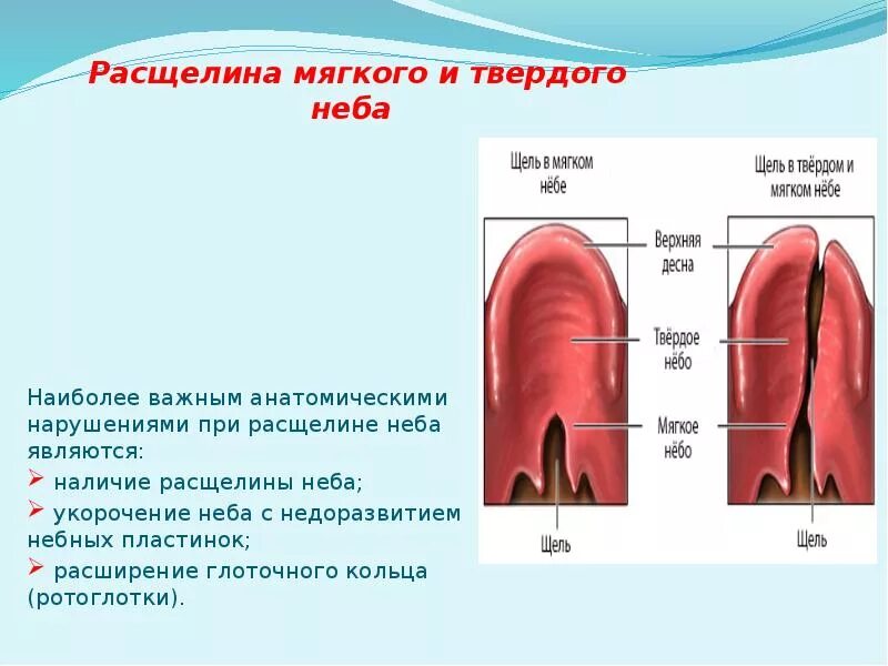 Расщелина мягкого неба фото Расщелина верхней губы и нёба