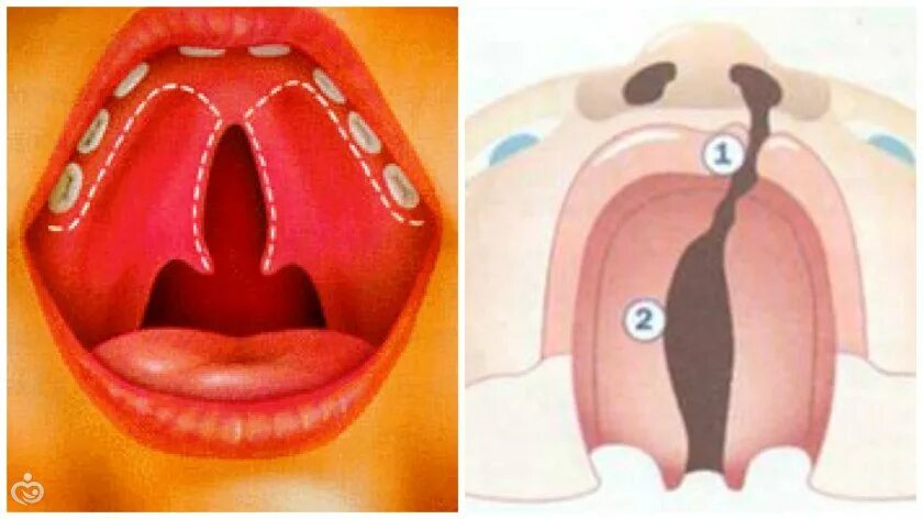 Расщелина мягкого неба фото Заячья губа рисунок