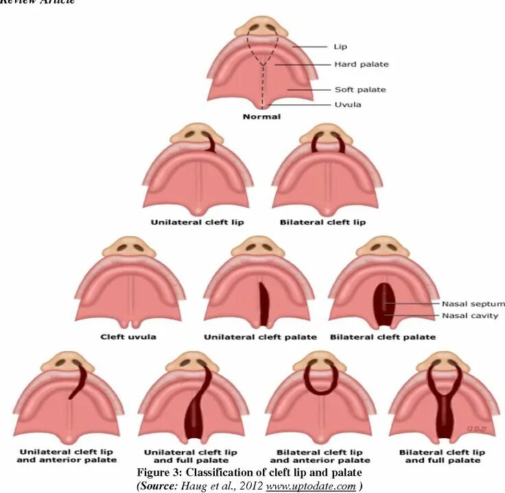 Расщелина мягкого неба у новорожденного фото Classification of Cleft Lip and Palate Color Diagram