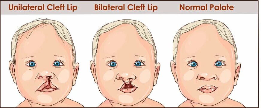 Расщелина мягкого неба у новорожденного фото Cleft Lip Зображення - огляд 4,432 Стокові фото, векторні зображення й відео Ado