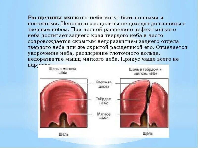 Расщелина мягкого неба у новорожденного фото Расщелина неба фото - ViktoriaFoto.ru