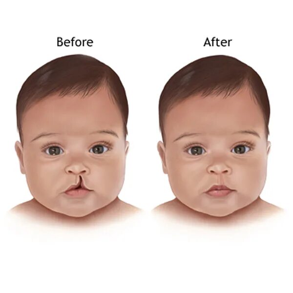 Расщелина неба у новорожденного фото с пояснениями Cleft lip and Cleft Palate - Symptoms and Causes Medtalks