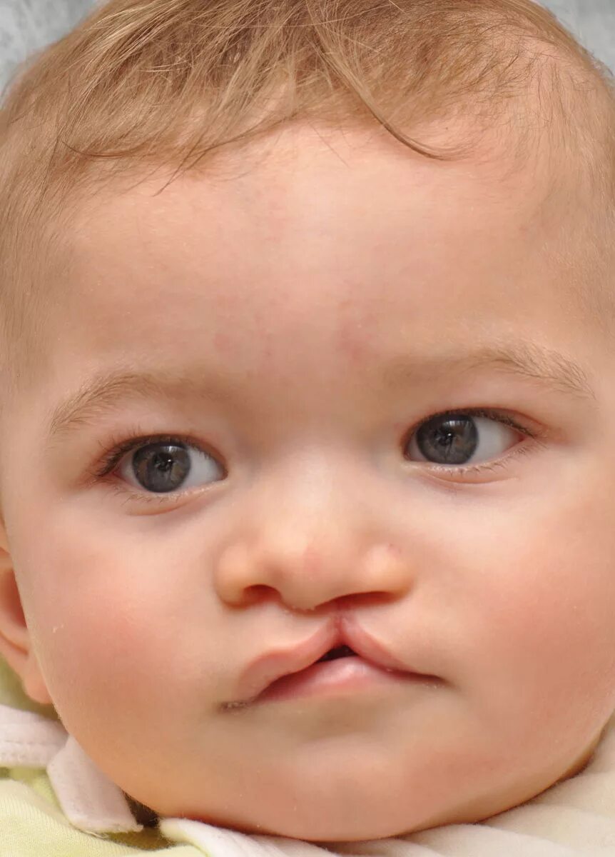 Расщелина неба у ребенка фото Cleft Lip Hellenic Craniofacial Center