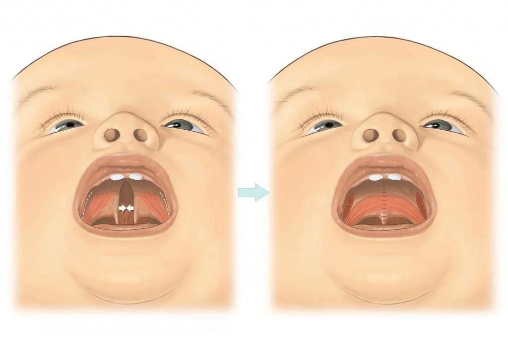 Расщелина неба у ребенка фото Что такое расщелина твердого неба и как помочь?