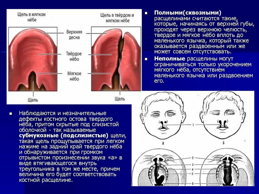 Расщелина неба у ребенка фото Расщелина неба фото - ViktoriaFoto.ru