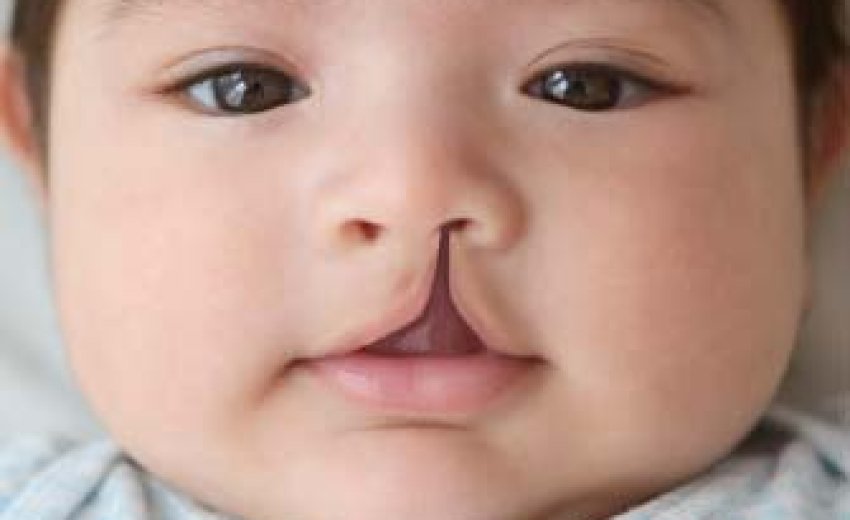 Расщелина неба у ребенка фото 100 operated on for cleft lip SikhNet