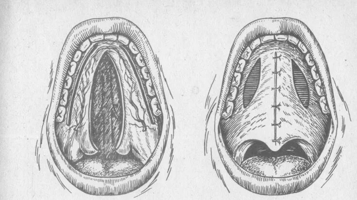 Расщелина твердого неба фото Cleft palate and lips: causes, groups of anomalies, therapeutic approaches - Est