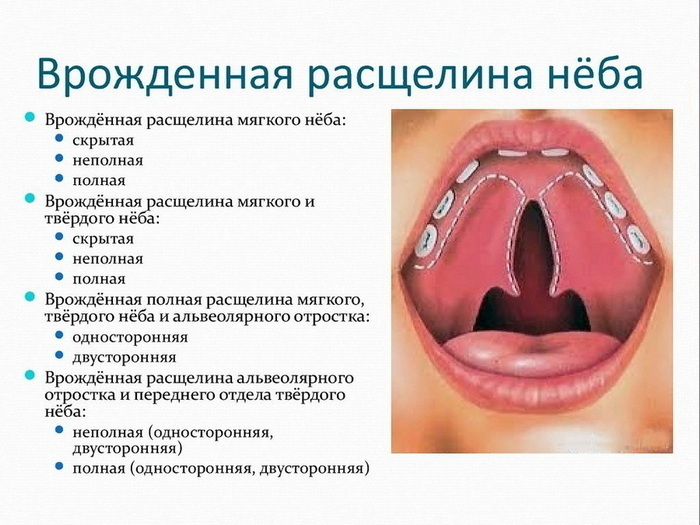 Расщелина твердого неба фото Каппацизм у детей и взрослых - причины, диагностика и лечение