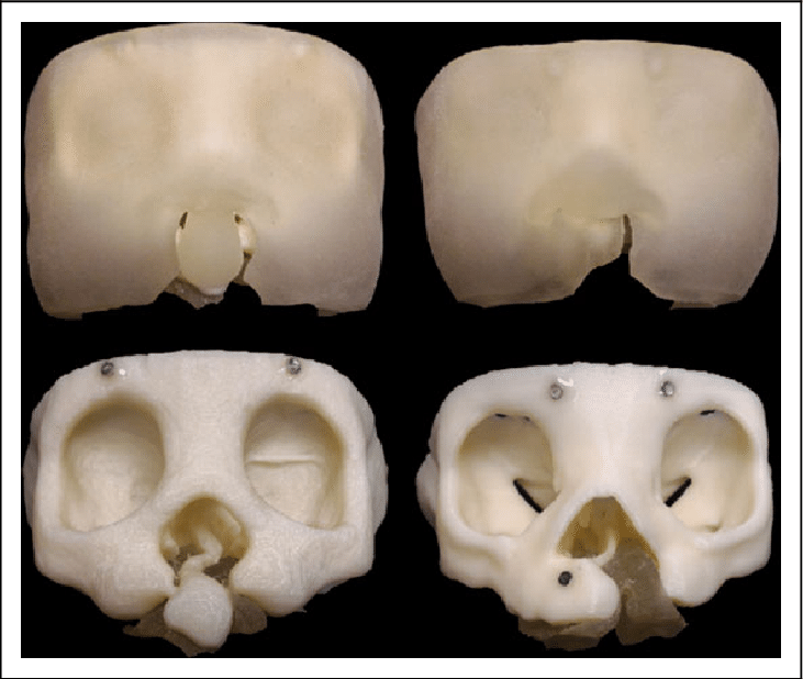 Расщепление неба фото Frontal view of 3D models of bilateral cleft lip/palate (left column)... Downloa